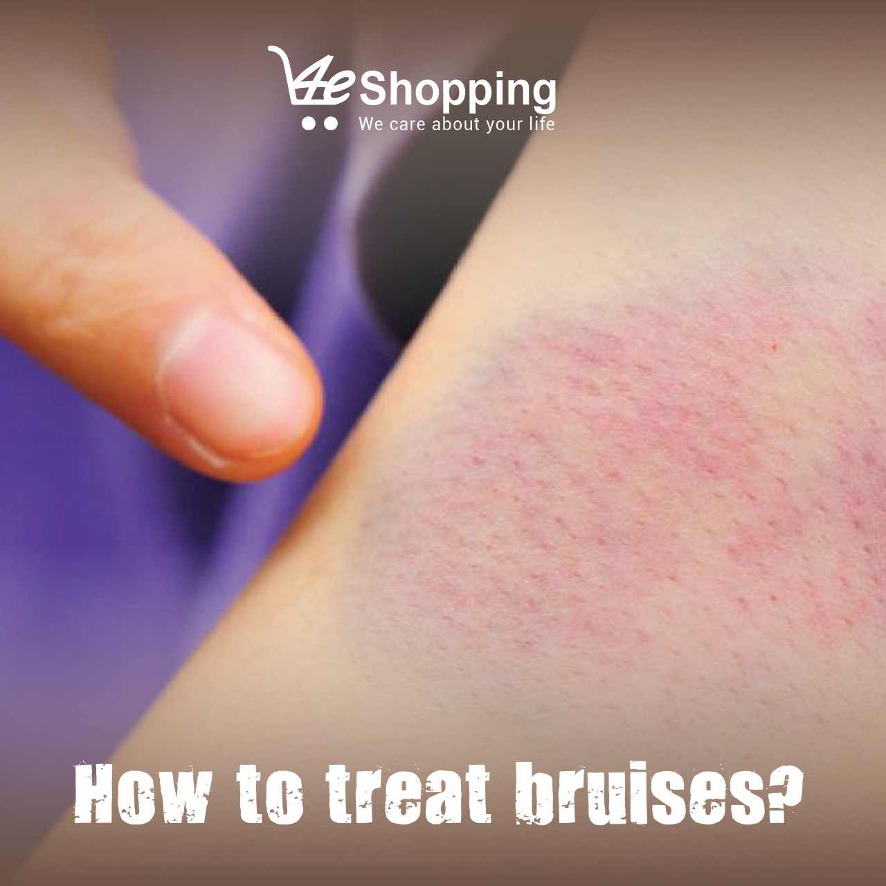 How-to-treat-bruises?